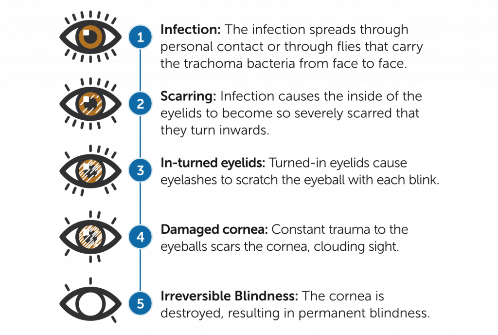 A 5-step infographic, titled "How does Trachoma cause Blindness?" Step 1 shows a normal eyeball with full eyelashes with text "1. Infection: The infection spreads through personal contact or through flies that carry the trachoma bacteria from face to face." Step 2 shows and eyeball with minor scratches on the cornea and a few lost eyelashes with text "2. Scarring: Infection causes the inside of the eyelids to become so severely scarred that they turn inwards." Step 3 shows an eyeball with moderate scratches on the cornea and more lost eyelashes with text "3. In-turned eyelids: Turned-in eyelids cause eyelashes to scratch the eyeball with each blink." Step 4 shows an eyeball with major scratches on the cornea and many lost eyelashes with text: "4. Damaged cornea: Constant trauma to the eyeballs scars the cornea, clouding sight." Step 4 shows an eyeball with a white cornea and only 3 eyelashes with text: "5. Irreversible Blindness: The cornea is destroyed, resulting in permanent blindness."