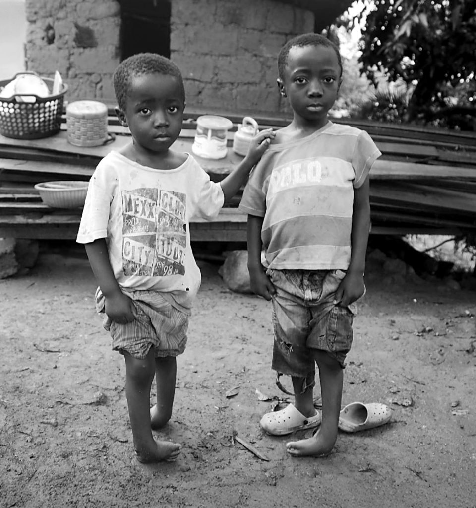 Two children standing on clubfeet in mud outside.