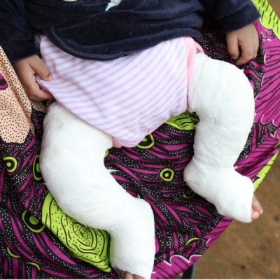 A baby's legs and feet in long leg casts