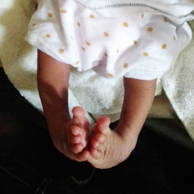 A baby's feet affected by clubfoot, turned inward and upward