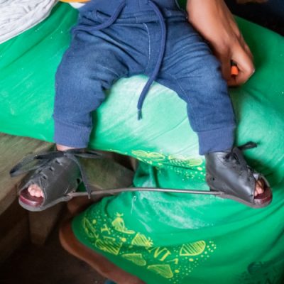 A baby's feet wearing braces.